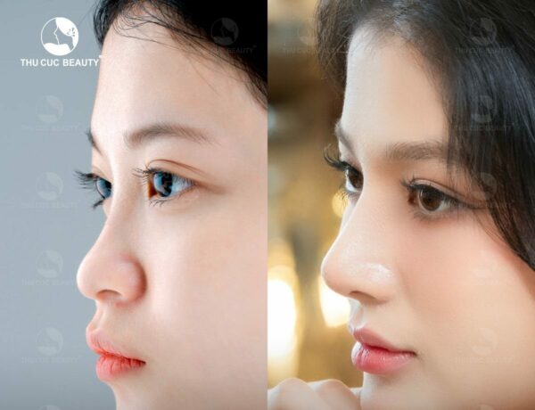 Nâng mũi sụn tai giá bao nhiêu? Cập nhật bảng giá nâng mũi mới hiện nay 3 Nâng mũi sụn tai giúp kéo dài tuổi thọ cho mũi.