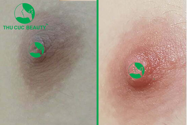 Làm hồng nhũ hoa bao nhiêu tiền? Phun hồng nhũ hoa có đắt không? 2 Làm hồng nhũ hoa giá khoảng từ 5 triệu đồng.