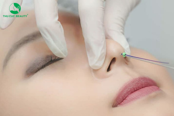 Nên nâng mũi bằng chỉ hay tiêm filler? 1 Nên nâng mũi bằng chỉ hay tiêm filler?
