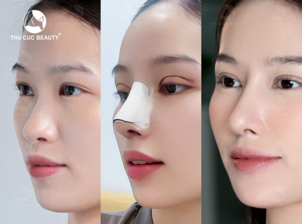 Nâng mũi sụn bao lâu thì sụn bám chắc? 3 Nâng mũi sụn bao lâu thì sụn bám chắc?