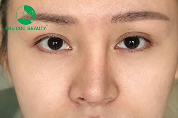 Nâng mũi sau bao lâu thì làm lại được? 2 Nâng mũi sau bao lâu thì làm lại được?