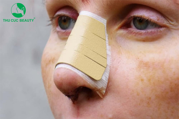 Nâng mũi sau bao lâu thì làm lại được? 1 Nâng mũi sau bao lâu thì làm lại được?