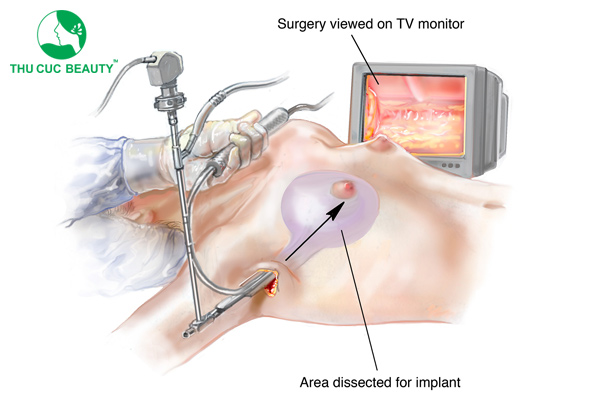 Nâng ngực nội soi giúp hạn chế xâm lấn, kiểm soát máu tốt.