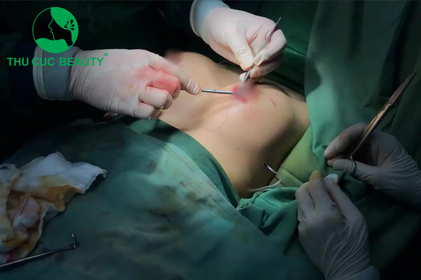 Nâng ngực đường quầng vú cho tính thẩm mỹ cao, che sẹo tốt.