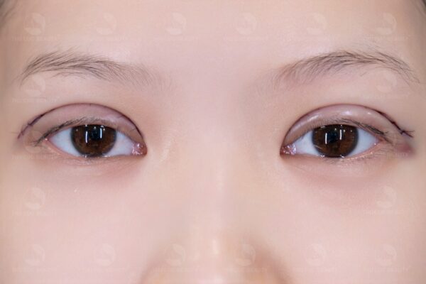 Cắt mí bao lâu thì hết sẹo? Làm sao để sẹo cắt mí nhanh lành? 3 Mí mắt sưng nhẹ sau khi vừa phẫu thuật xong.