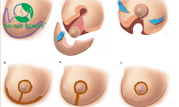 Sẹo phẫu thuật treo ngực sa trễ.