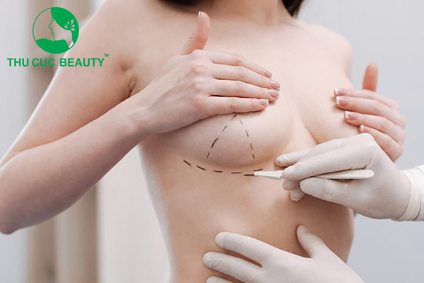 Sẹo treo ngực sa trễ.