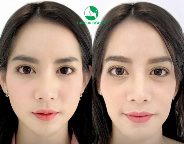 Tiêm filler má giữ được bao lâu? Làm sao để đẹp tự nhiên? 1 Tiêm filler má giữ được bao lâu?