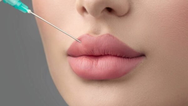 Tiêm filler môi giá bao nhiêu?