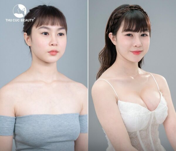 Giải pháp cho ngực lép sau sinh.