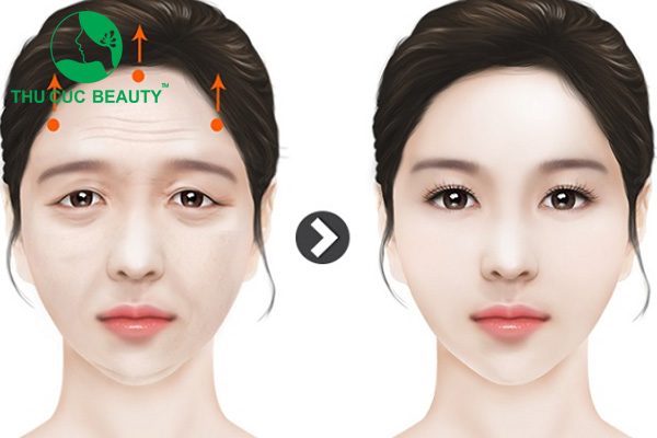 Nâng cung mày ở đâu đẹp? Chia sẻ kinh nghiệm khi đi nâng cung mày 1 Hiệu quả sau khi nâng cung mày.