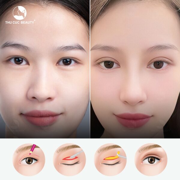 Cắt mí có đắt không sẽ phụ thuộc vào cơ sở thẩm mỹ và phương pháp thực hiện.