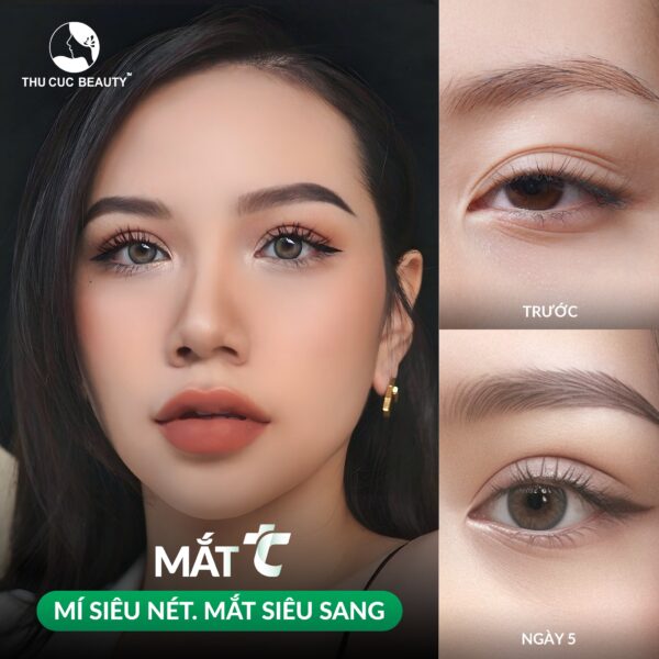 Cắt mí an toàn và hiệu quả tại Bệnh viện Thẩm mỹ Thu Cúc.