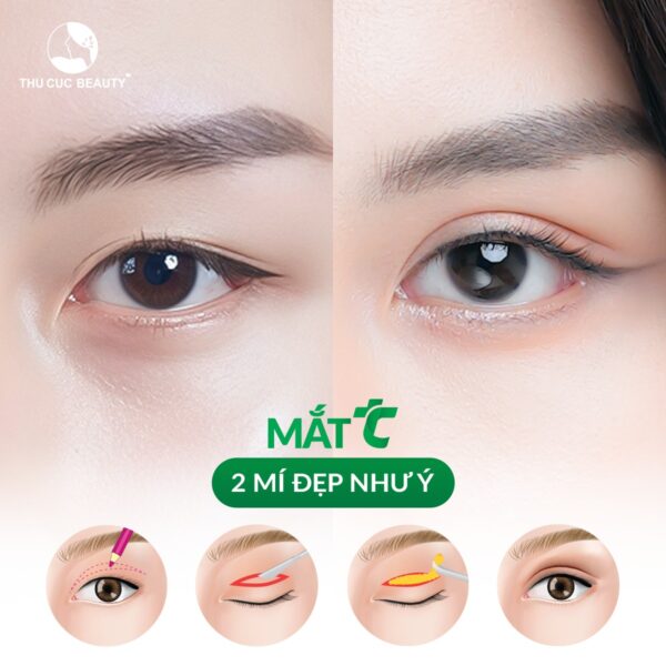 Cắt mí kiêng đồ nếp bao lâu?