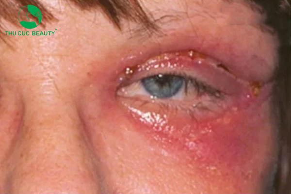 Cắt mí mắt bị nhiễm trùng.