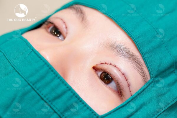 Cắt mí mắt tại cơ sở uy tín để hạn chế biến chứng.
