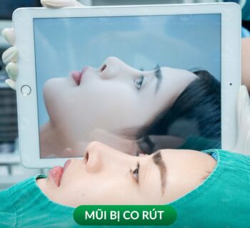 Nâng mũi bị co rút: Nguyên nhân và cách khắc phục