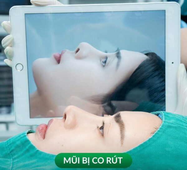 Nâng mũi bị co rút: Nguyên nhân và cách khắc phục 3 Phẫu thuật chỉnh sửa mũi hỏng.