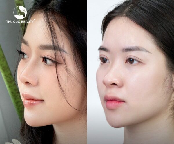 Các dáng mũi đẹp hiện nay, nâng mũi ở đâu uy tín? 2 Dáng mũi S-line đẹp