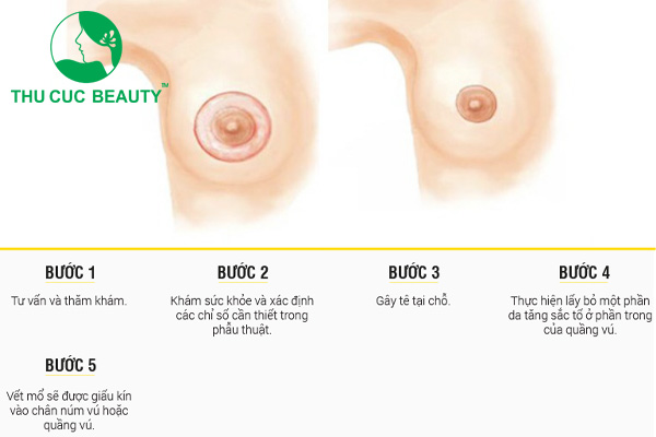 Thu nhỏ quầng vú bao nhiêu tiền?