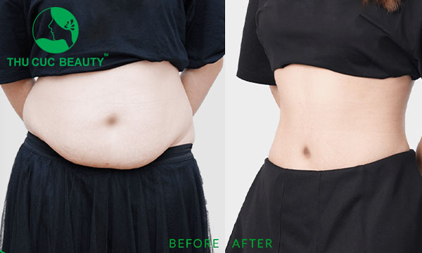 Hút mỡ và những thắc mắc thường gặp.