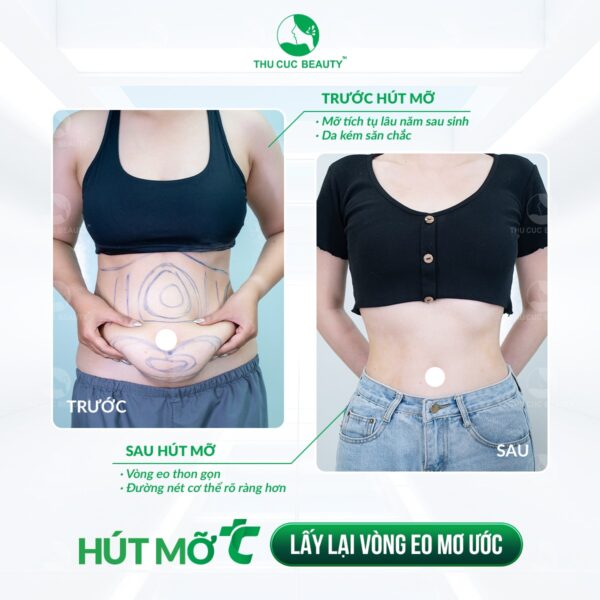 hut mo bung va dieu can biet e1770276607242