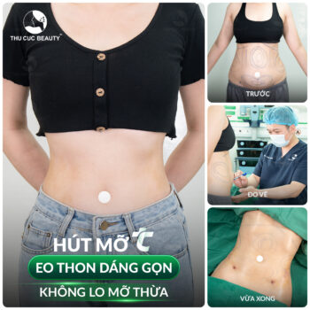 Hút mỡ có đau không? Những điều cần biết khi hút mỡ