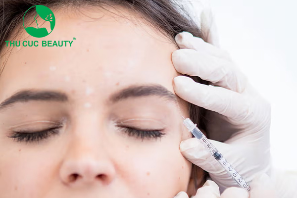 Tiêm filler giúp cải thiện thái dương hóp nhanh chóng.