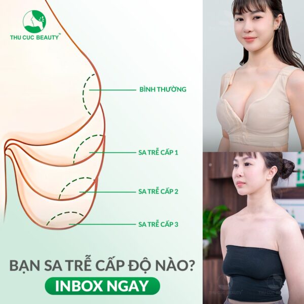 khi nao can treo nguc sa tre e1759222439895