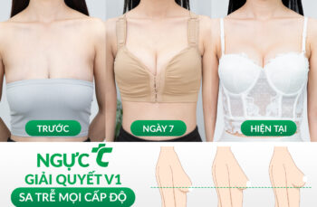 Phân biệt nâng ngực và treo ngực sa trễ
