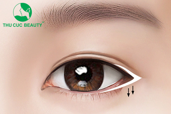 Mở rộng góc mắt giá bao nhiêu? 