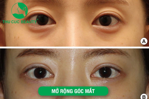 Mở rộng góc mắt