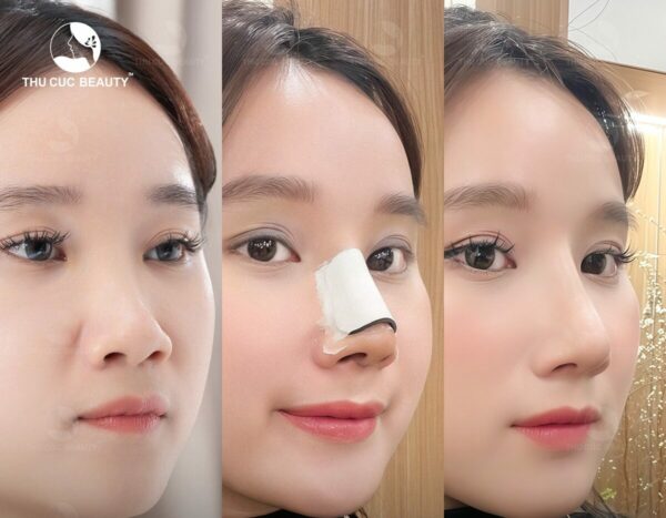 Quy trình nâng mũi cấu trúc