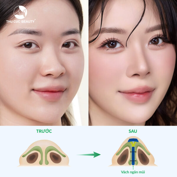 Nâng mũi cấu trúc giúp khắc phục các nhược điểm của mũi.