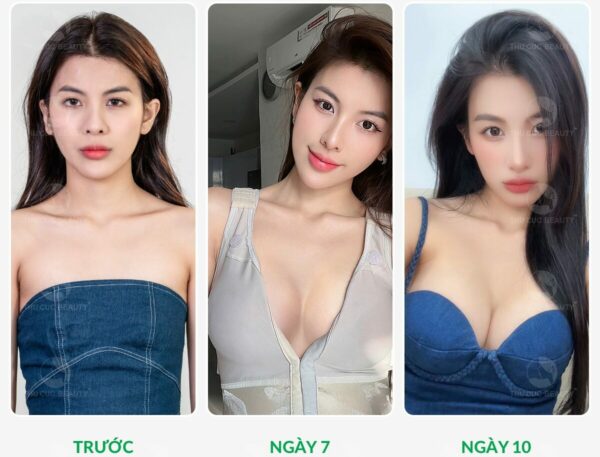 Lợi ích của nâng ngực