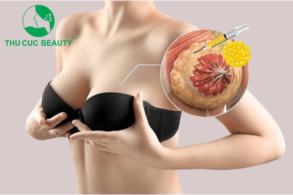 Nên phẫu thuật nâng ngực đặt túi độn hay nâng ngực bằng mỡ tự thân? 2 Nên phẫu thuật nâng ngực hay nâng ngực bằng mỡ tự thân?