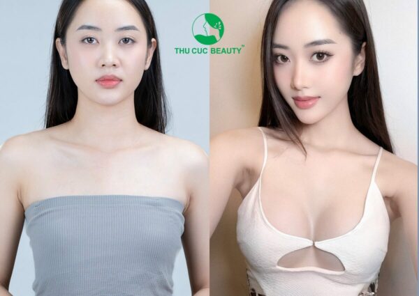 Nâng ngực và những điều cần biết