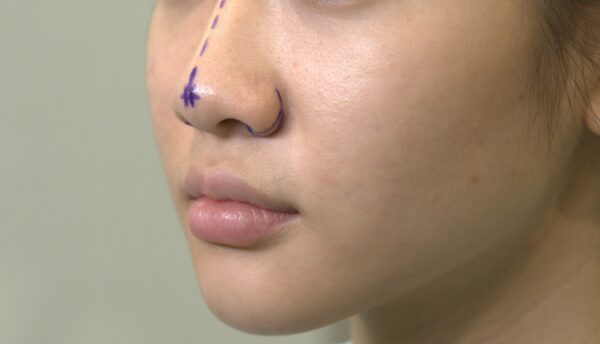 Quy trình thu gọn cánh mũi tại BVTM Thu Cúc