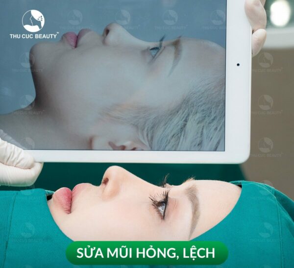 Nâng mũi lần 2 cần lưu ý những gì để tránh biến chứng? 1 Phẫu thuật chỉnh sửa mũi hỏng.