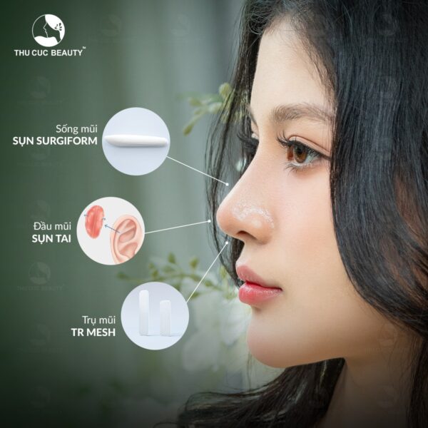 Nâng mũi sụn tai có vĩnh viễn không? Có nên nâng mũi sụn tai? 1 Nâng mũi cấu trúc cho hiệu quả tối ưu