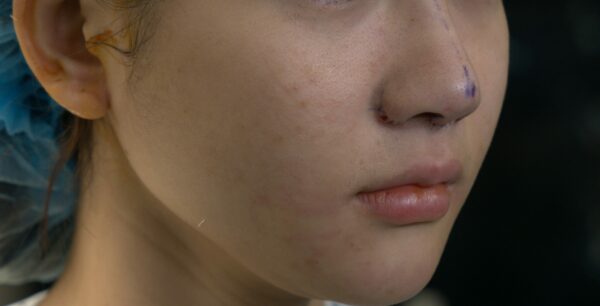 Quy trình thu gọn cánh mũi tại BVTM Thu Cúc