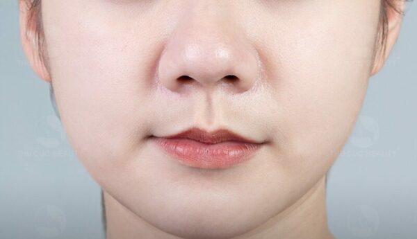 Những ai cần thu gọn cánh mũi? Tại sao nên thu gọn cánh mũi?