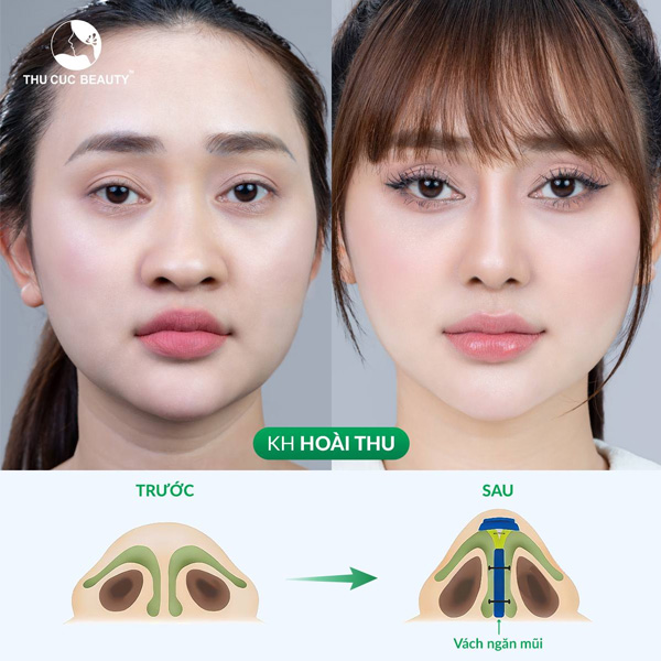 Thu hẹp nền mũi là gì? Tại sao cần thu hẹp nền mũi? 1 Thu hẹp nền mũi giúp mũi trông cao thẳng, thon gọn hơn.