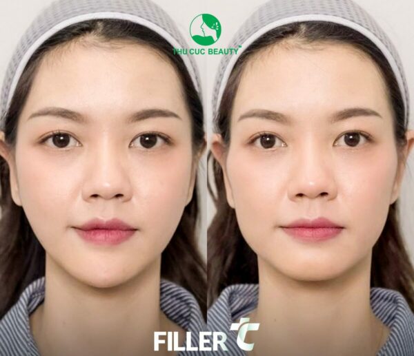 Tiên Filler giúp gương mặt cân đối, trẻ trung hơn.