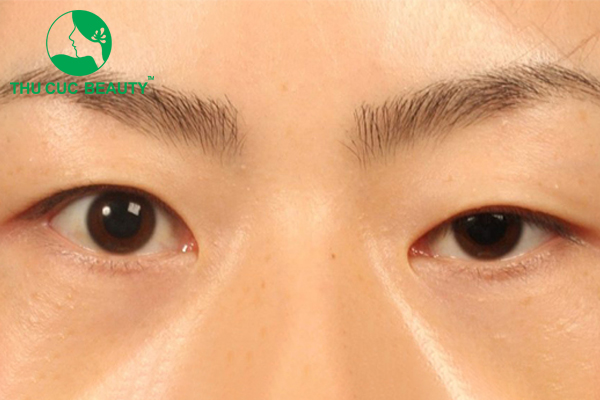 Phẫu thuật sụp mí mắt: Tái sinh đôi mắt trẻ trung 1 Phẫu thuật sụp mí mắt giúp đôi mắt cân đối hơn.
