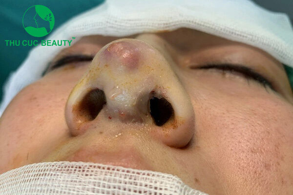 Trường hợp nào cần sửa mũi sau khi nâng? 2 Chỉnh sửa mũi hỏng do bị nhiễm trùng sau khi nâng.