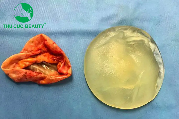 Nâng ngực bị bao xơ có nguy hiểm không? 2 Nâng ngực bị bao xơ