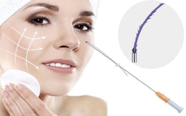 Căng da mặt không phẫu thuật - Xu hướng trẻ hóa da hiện đại 1 cang da mat bang chi la gi e1759920984889