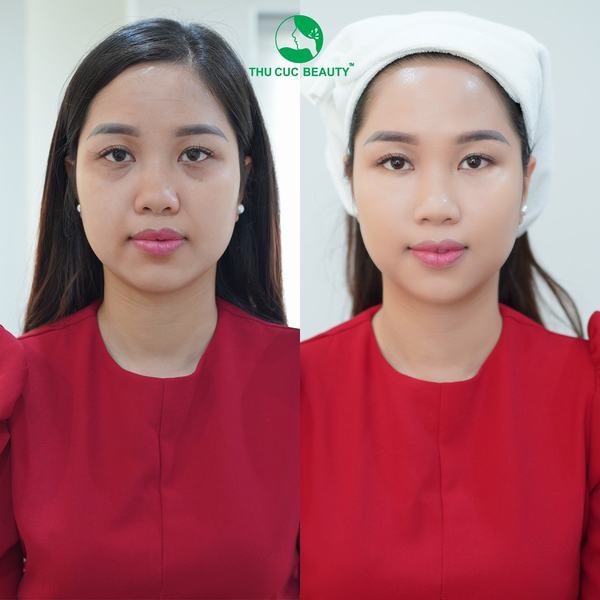 Giải pháp giúp duy trì kết quả nâng cơ căng da 1 Căng da nâng cơ mặt trẻ hóa