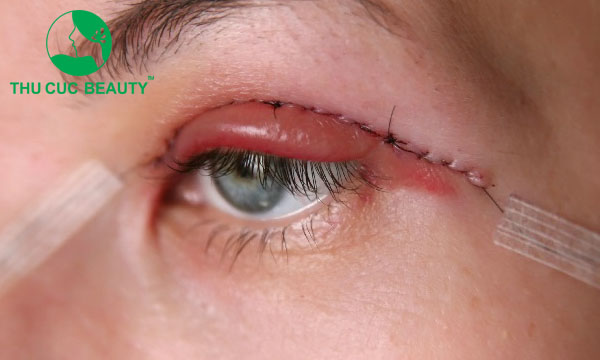 Nguyên nhân cắt mí bị trợn